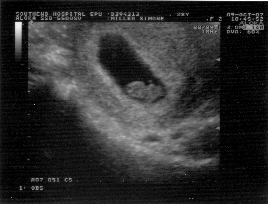 Got my first ultrasound today & could see a tiny thin sac ...
